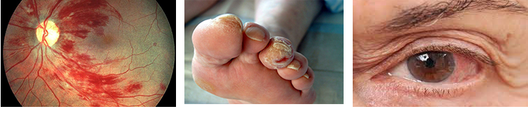 Derrame, Pie diabetico, Desprendimiento